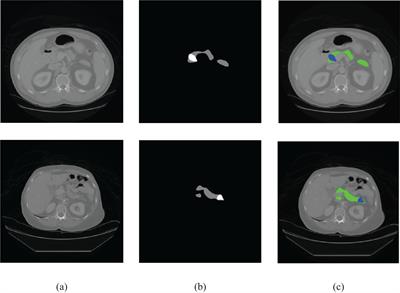 Weakly supervised large-scale pancreatic cancer detection using multi-instance learning